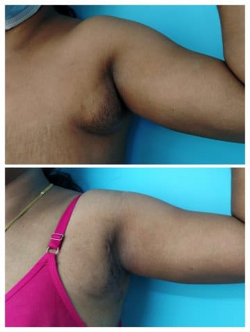 കക്ഷത്തിലുള്ള സ്തനം: ചികിത്സയ്ക്ക് മുൻപും ശേഷവും