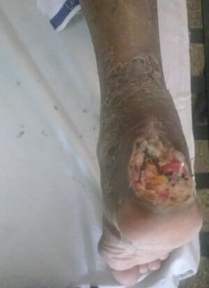 അണുബാധയേറ്റ ഡയബറ്റിക് അൾസർ